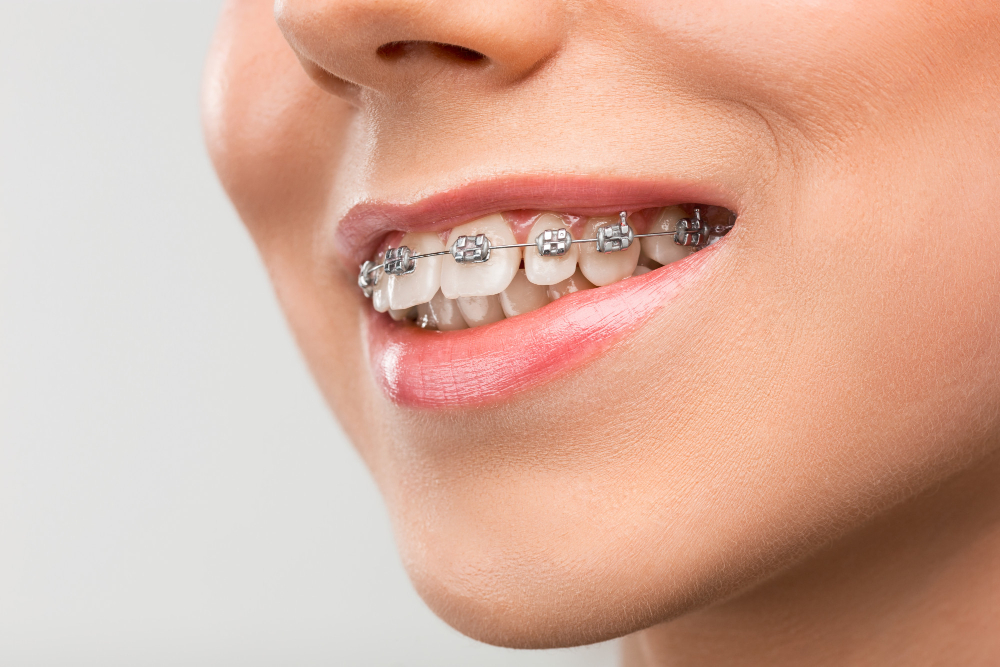 Aparatul dentar: cum știi dacă ai nevoie de el și ce tipuri există